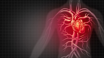 Coronary heart disease is the result of plaque buildup in the arteries of the heart.