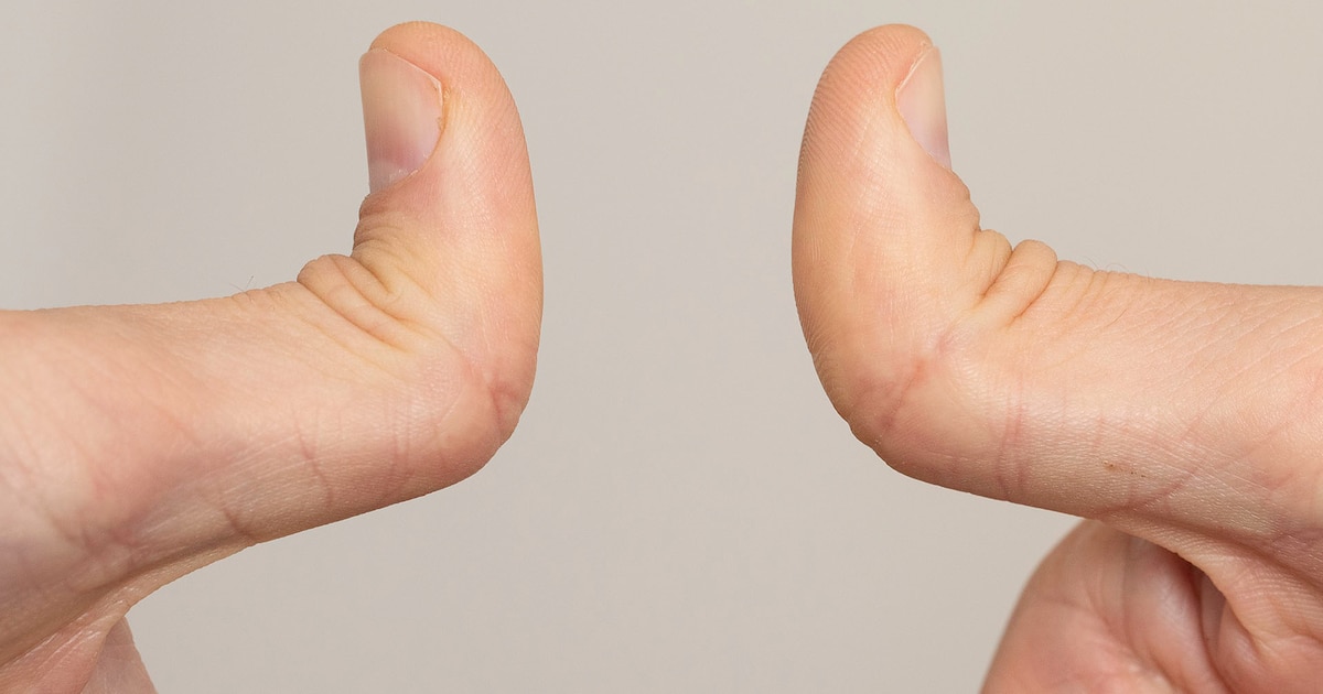 Why double-jointed people are more likely to have health problems